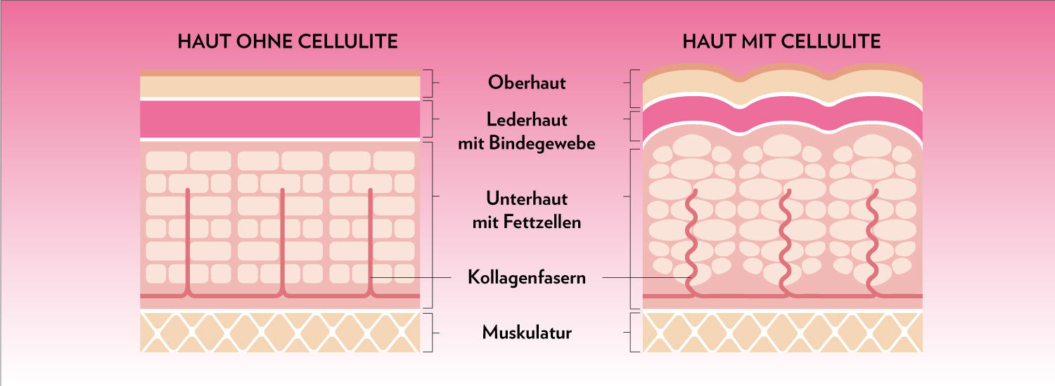 1500_210329_Cellulite